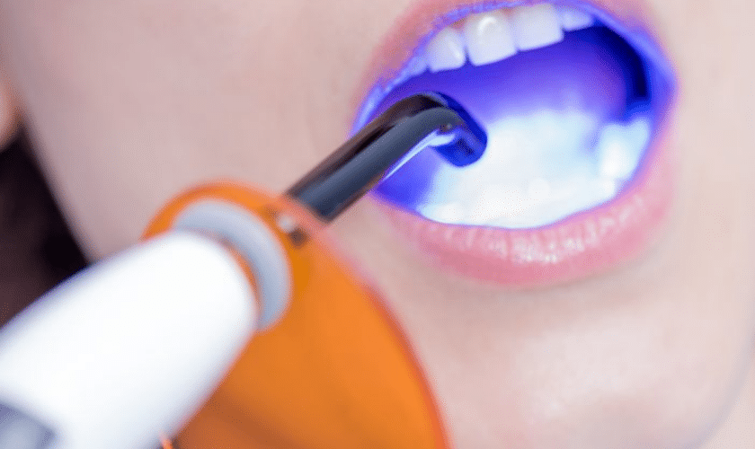 Cosmetic Bonding Treatment