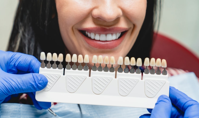 Dental Veneers