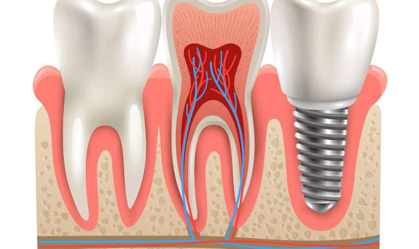 Dental Implant