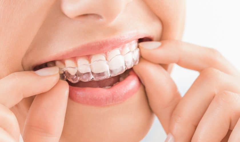 Perfecting Smiles, Unseen: The Ultimate Guide To Invisalign Treatment