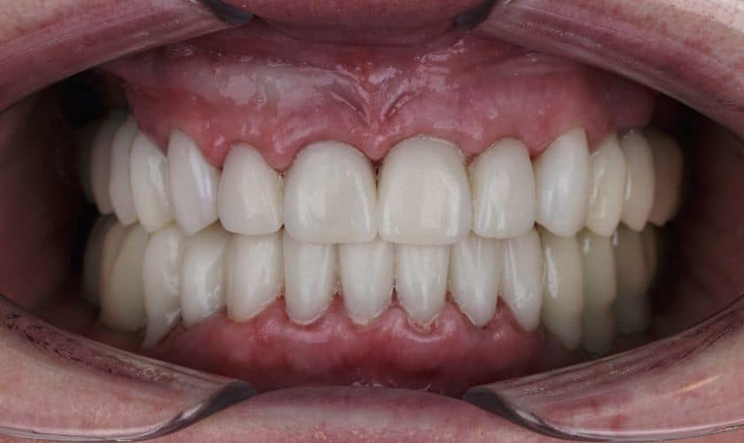 Transforming Smiles Seamlessly: All About Cosmetic Bonding Procedures