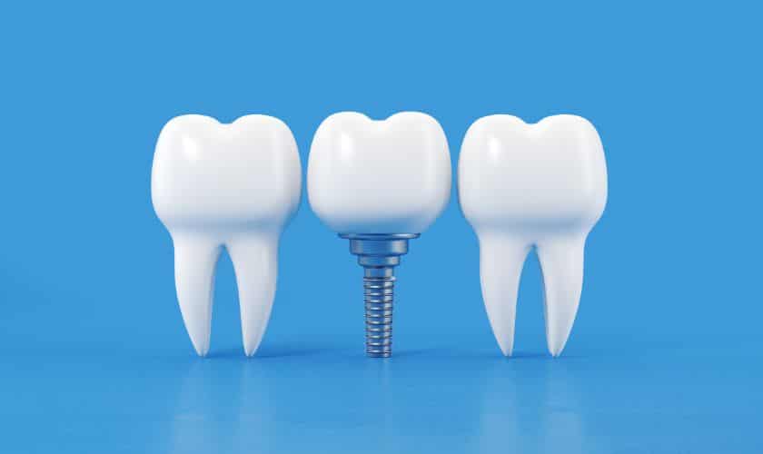 Unveiling The Transformative World Of Dental Implants