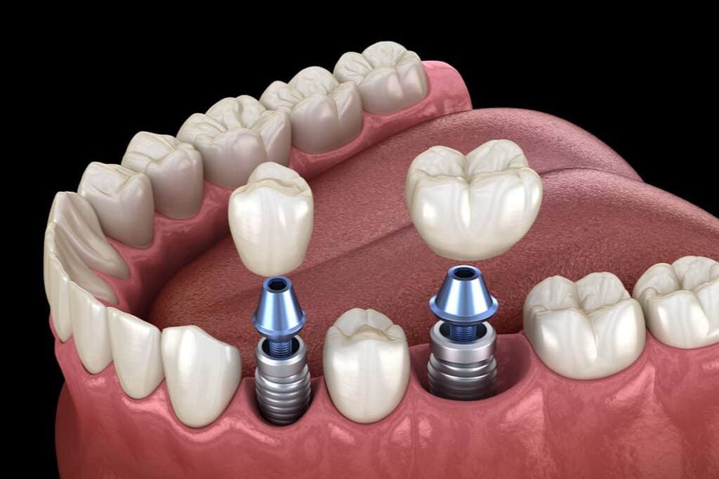 dental implants in North Salt Lake Dental