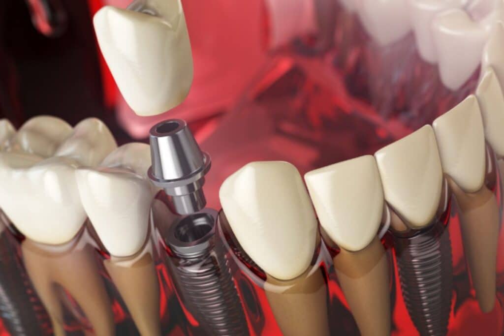 dental implants in North Salt Lake