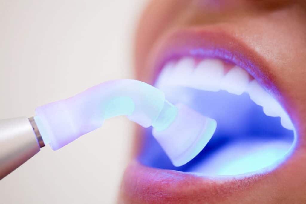 Cosmetic Bonding