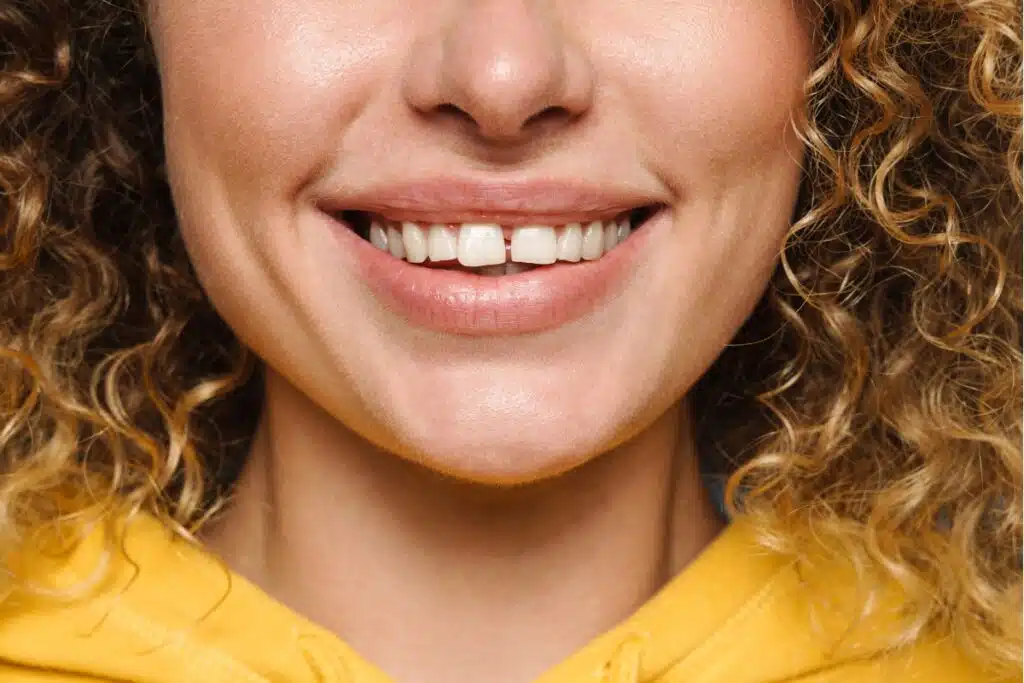 Is Cosmetic Bonding the Right Solution for Small Tooth Gaps